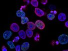 Cellules cancéreuses colorectales humaines traitées avec un inhibiteur